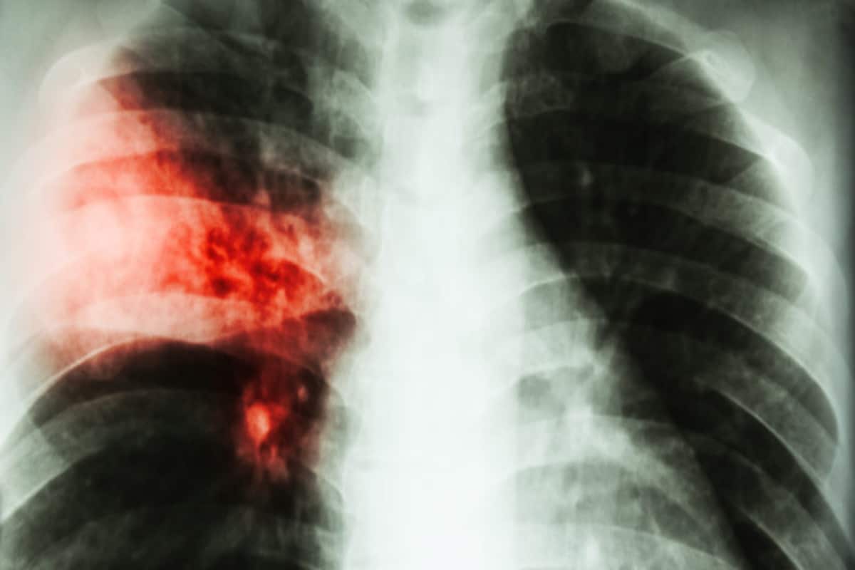 Tuberculosis