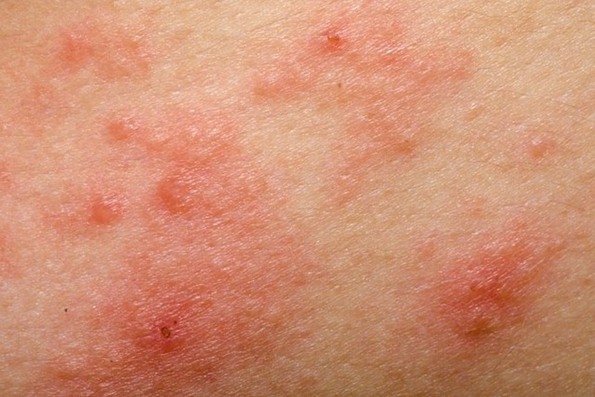 dermatitis