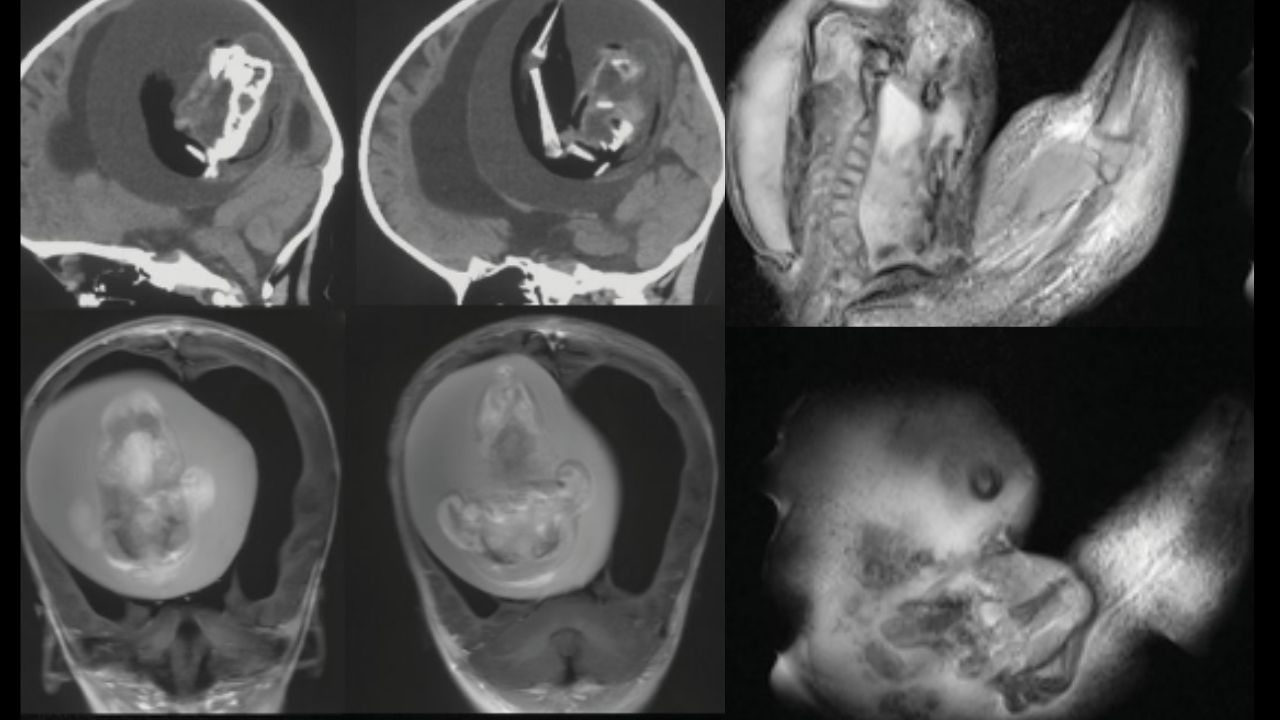 Científicos de la Universidad Fudan, Shanghái, China, extraen un feto- gemelo parásito-  del cerebro de una bebé de un año.