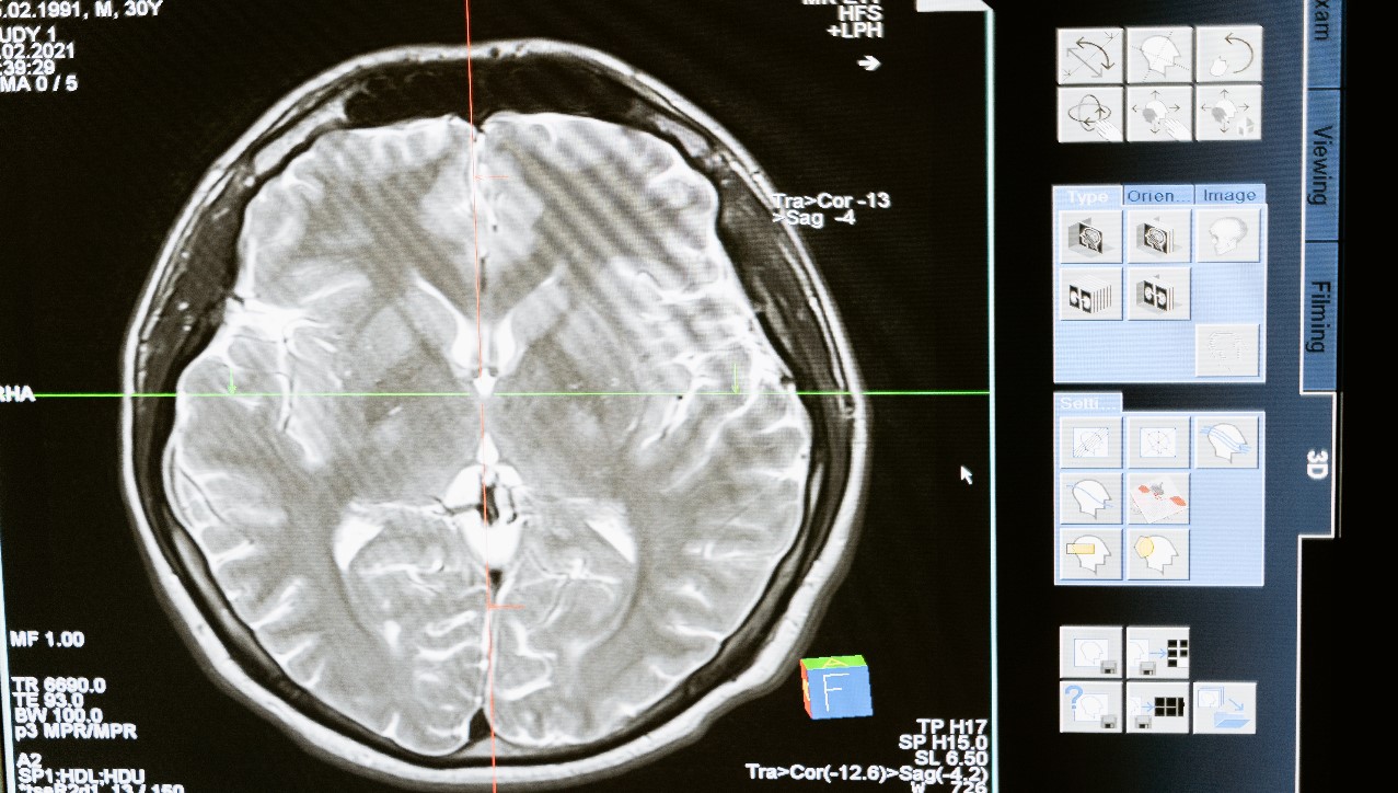 Klotho es la proteína que detiene el envejecimiento del cerebro