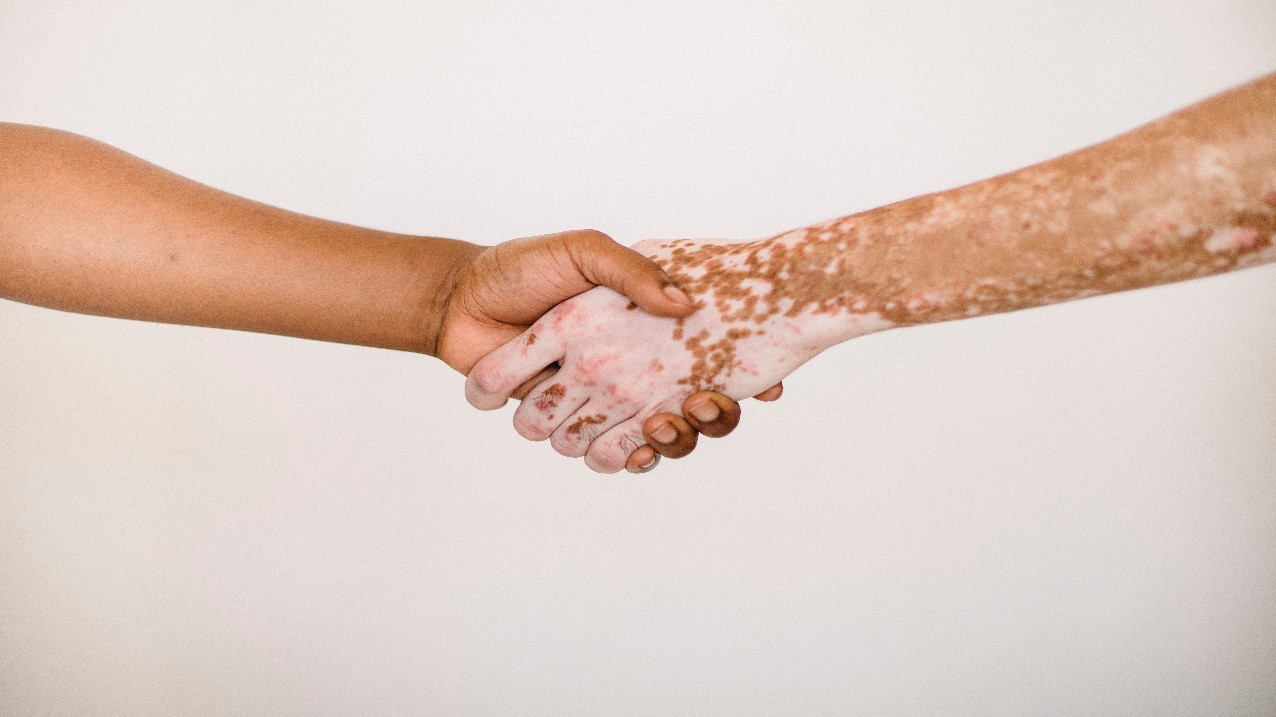 imagen de una persona que padece vitiligo