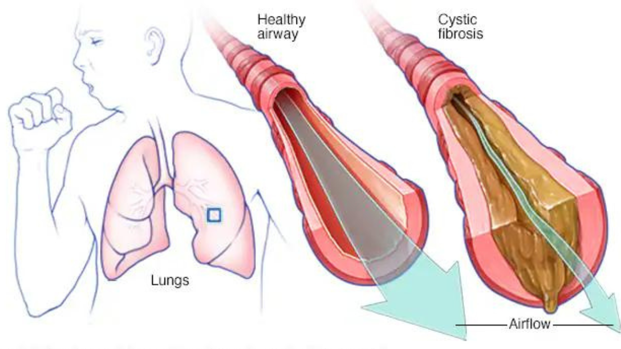 fibrosis quística