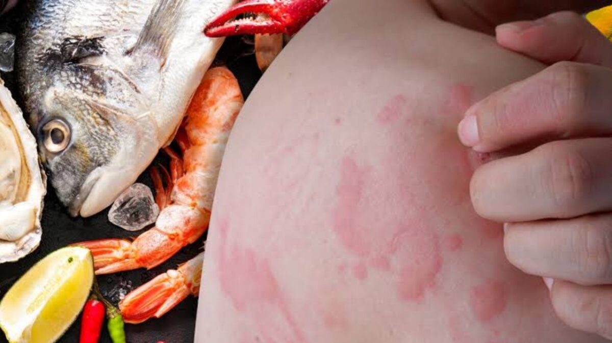 Signos de una intoxicación por mariscos
