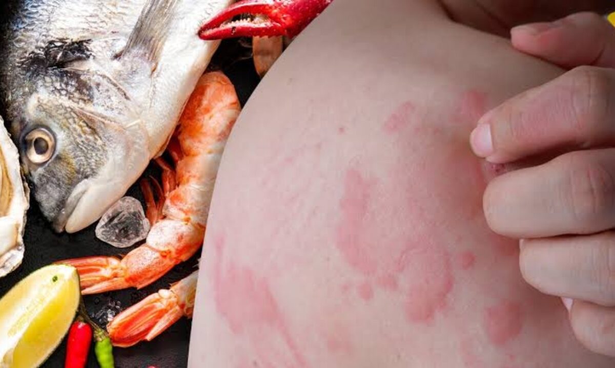 Signos de una intoxicación por mariscos