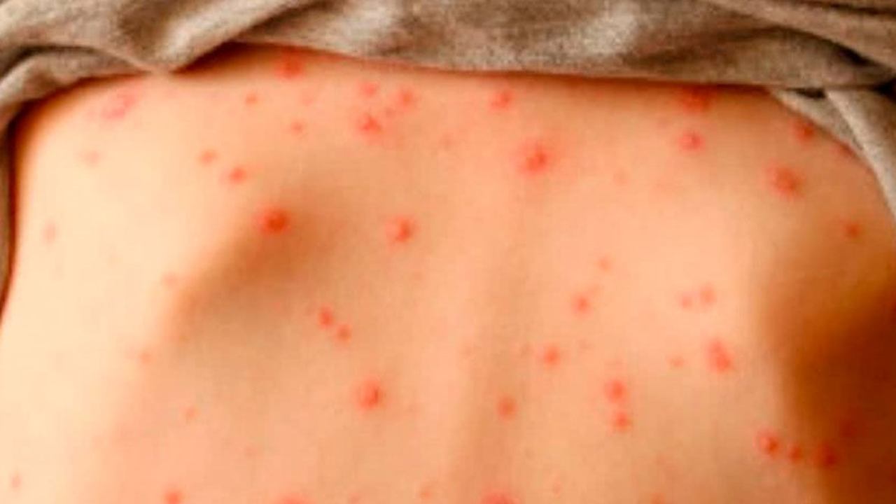 Measles can also cause serious complications, such as pneumonia and encephalitis (inflammation of the brain)