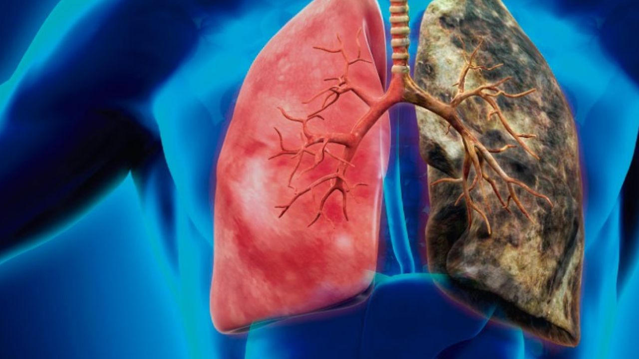 El medicamento abiraterona dirigido a pacientes con cáncer de próstata metastásico.