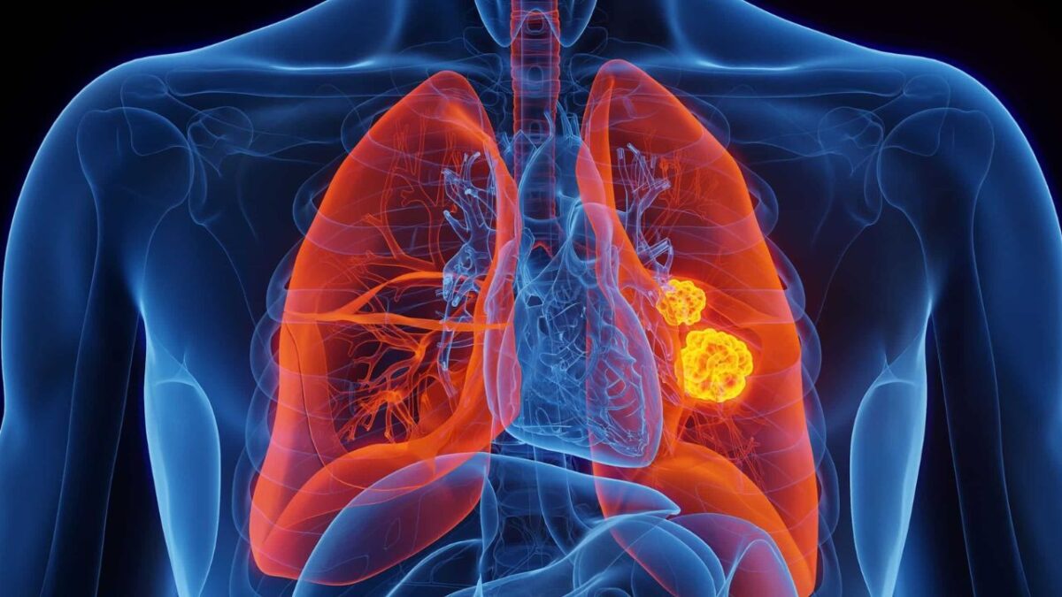 Algunos síntomas comunes del cáncer de pulmón incluyen tos persistente, dolor en el pecho, dificultad para respirar, sibilancias y tos con sangre
