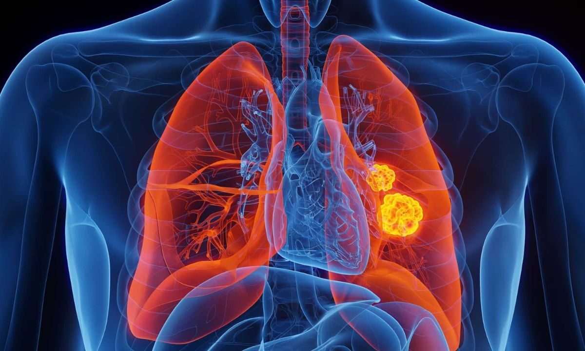 Algunos síntomas comunes del cáncer de pulmón incluyen tos persistente, dolor en el pecho, dificultad para respirar, sibilancias y tos con sangre