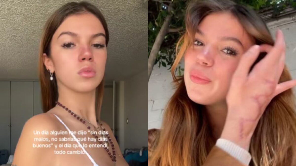 Valentina Gilabert mostró sus cicatrices del ataque que sufrió de la presunta agresora, Marianne "N".