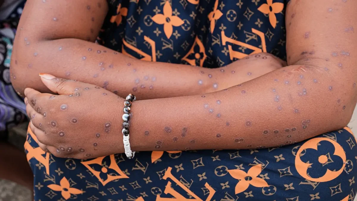 alerta por la epidemia de mpox