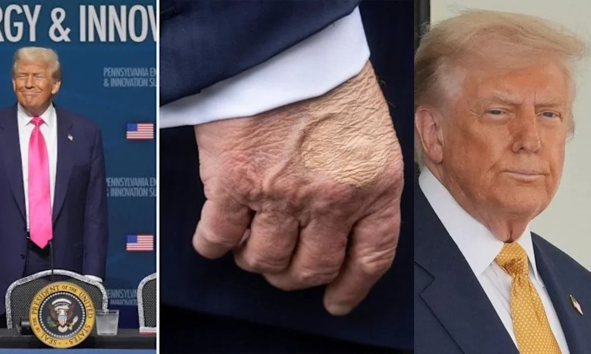 Diagnostican a Trump con insuficiencia venosa tras varios estudios